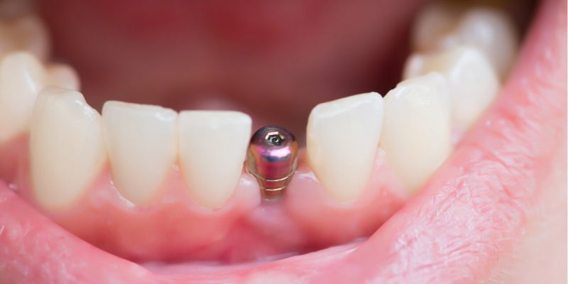 medicare and dental implants
