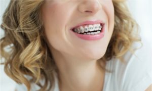 usage of braces for fixing overbite
