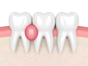 Should I Pop an Abscess on My Gum swelling