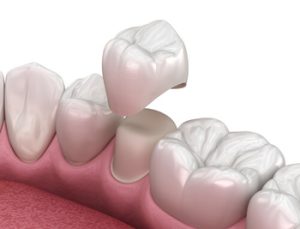 what does rotten teeth look like crown