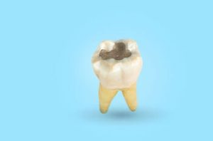 what does rotten teeth look like decay